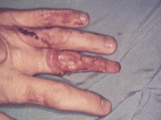 LESION (23)  IMAGENES FOTOS